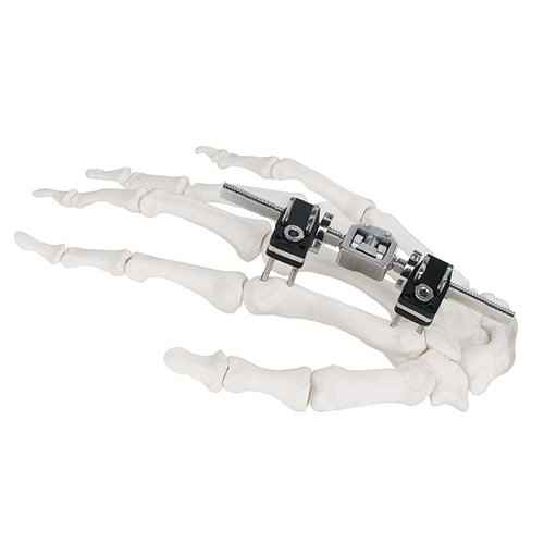 Mini Fragment External Fixator (Finger and Palm)