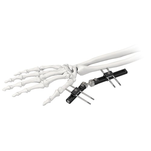 Wrist Joints External Fixator